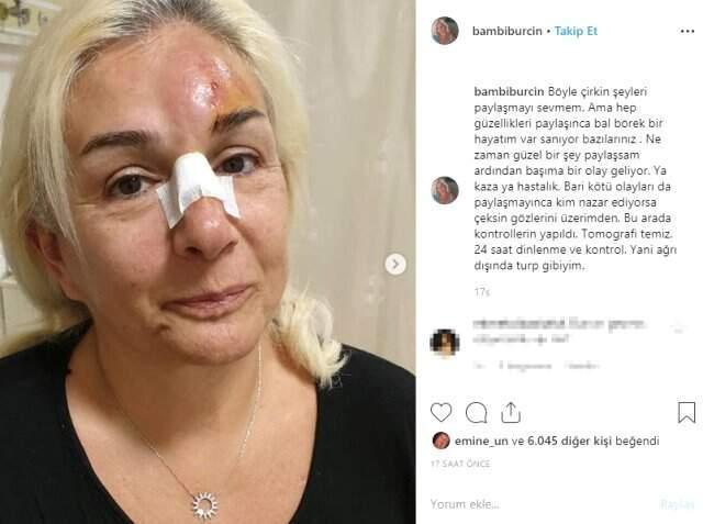 Oyuncu Burçin Orhon, Yüzüstü Düşerek Yaralandı
