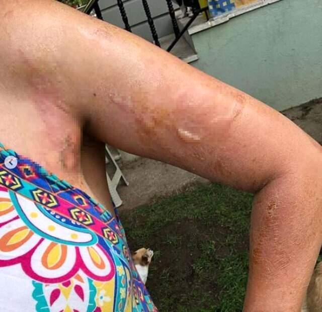 Evinde düdüklü tencere patlayan gelin adayı Sinem Umaş'ın vücudu yandı