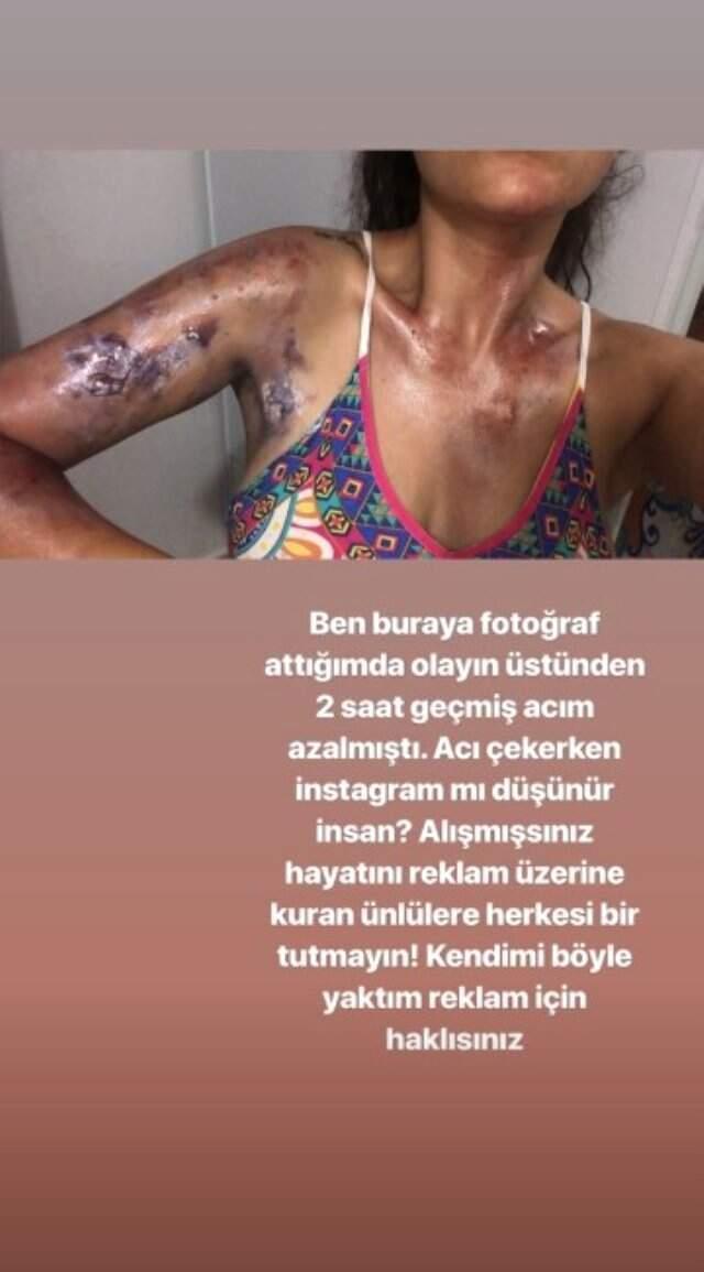 Evinde düdüklü tencere patlayan gelin adayı Sinem Umaş'ın vücudu yandı