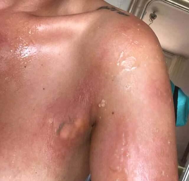 Evinde düdüklü tencere patlayan gelin adayı Sinem Umaş'ın vücudu yandı
