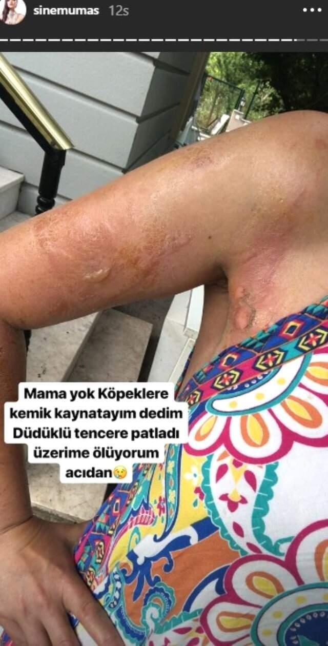 Evinde düdüklü tencere patlayan gelin adayı Sinem Umaş'ın vücudu yandı