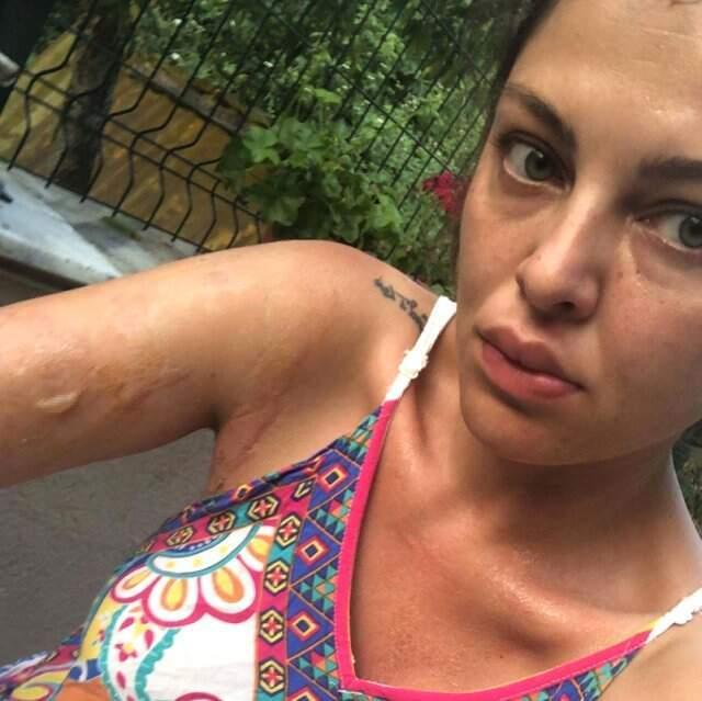 Evinde düdüklü tencere patlayan gelin adayı Sinem Umaş'ın vücudu yandı