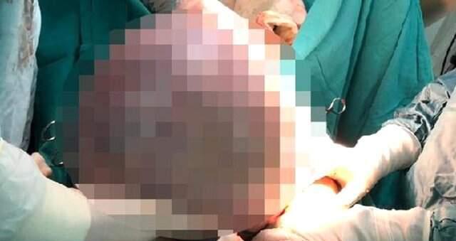 Solunum şikayetiyle doktora gitti! Karnından çıkan, doktorları bile hayrete düşürdü