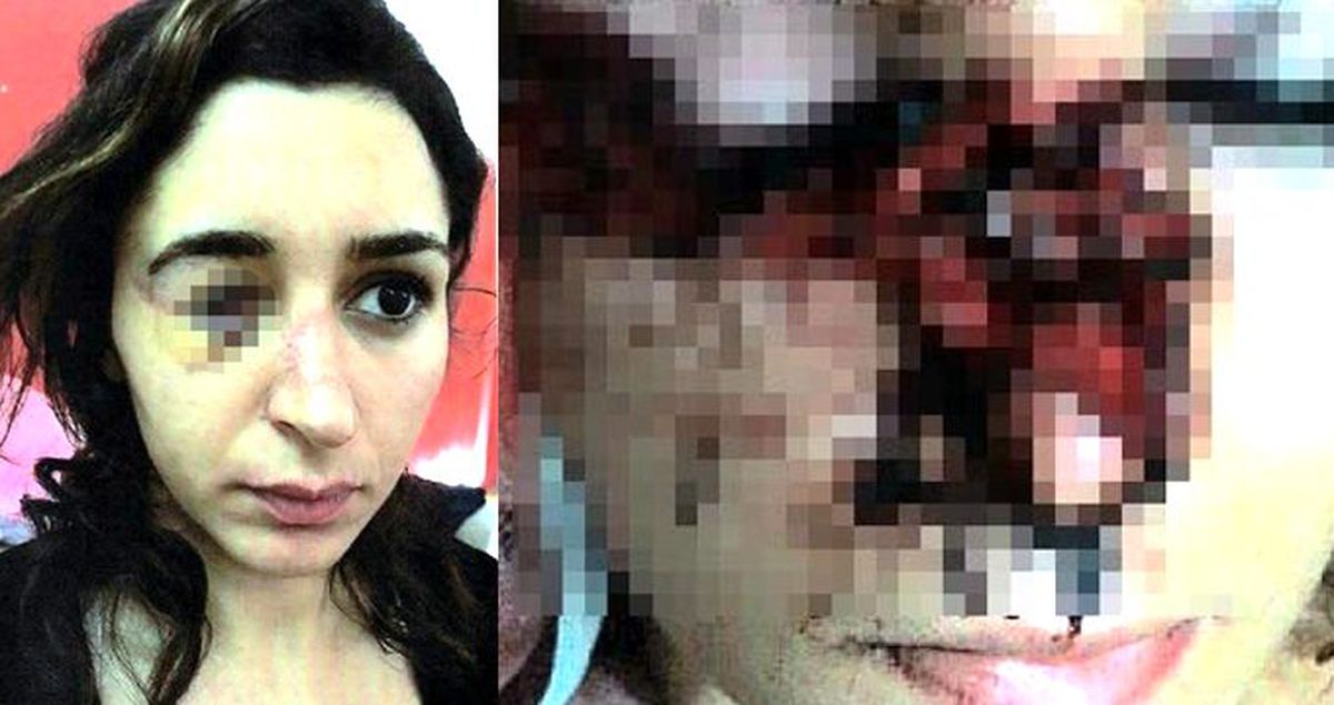 Sevgiliyken yüzünü parçalayan adamla evlenen Tuğçe, 'Artık korkmayacağım' deyip ilk adımı attı