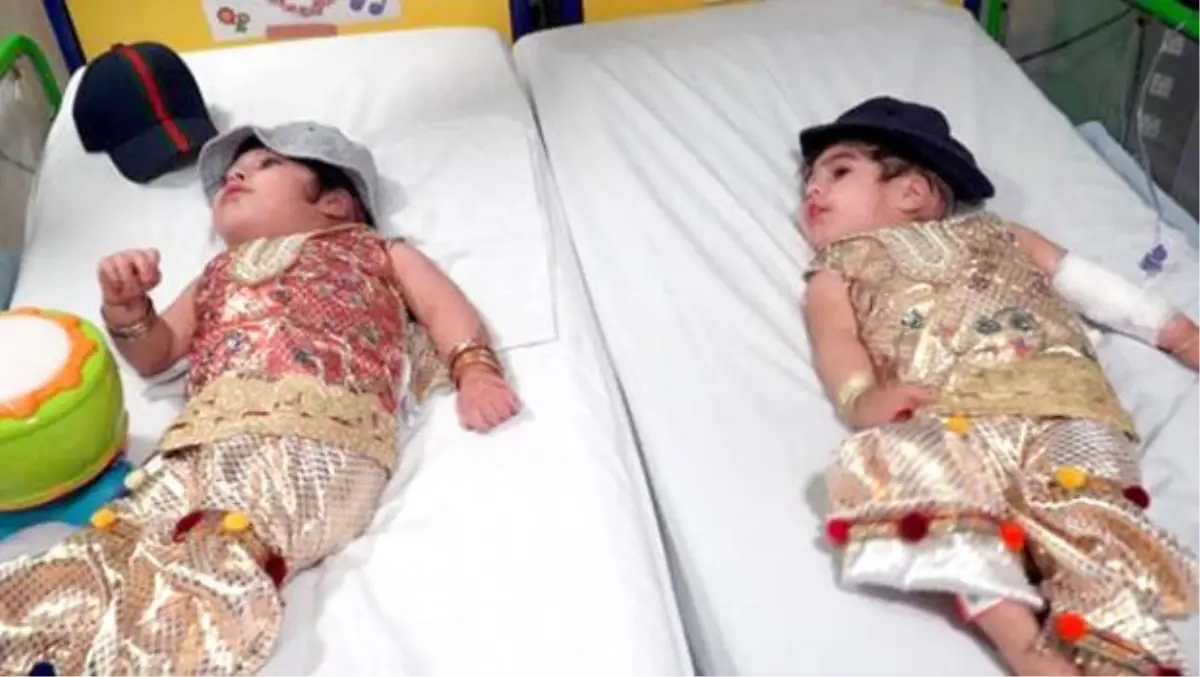 Yapışık ikizler 50 saatlik ameliyatla ayrıldı
