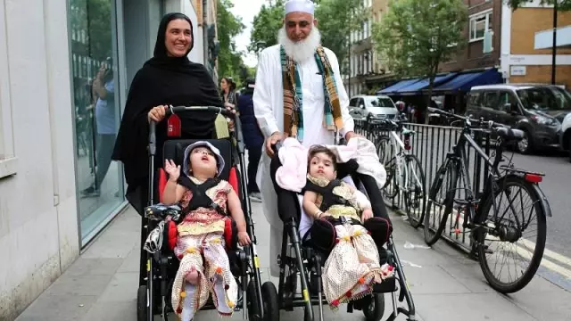Yapışık ikizler 55 saatlik ameliyatla ayrıldı