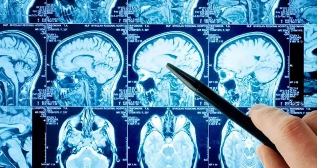 Doktorlar bile şaştı kaldı! 60 yıl beyninin yarısı olmadan yaşadı