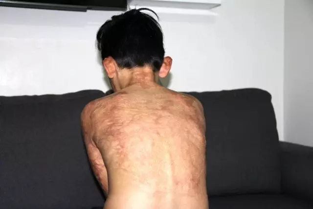 (Özel) Vücudu yanan Umut'un acı çığlığı: 'Eski derimi istiyorum' (Özel) Vücudu yanan Umut'un acı çığlığı: 'Eski derimi istiyorum'