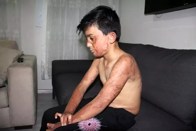 (Özel) Vücudu yanan Umut'un acı çığlığı: 'Eski derimi istiyorum' (Özel) Vücudu yanan Umut'un acı çığlığı: 'Eski derimi istiyorum'