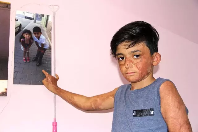 (Özel) Vücudu yanan Umut'un acı çığlığı: 'Eski derimi istiyorum' (Özel) Vücudu yanan Umut'un acı çığlığı: 'Eski derimi istiyorum'