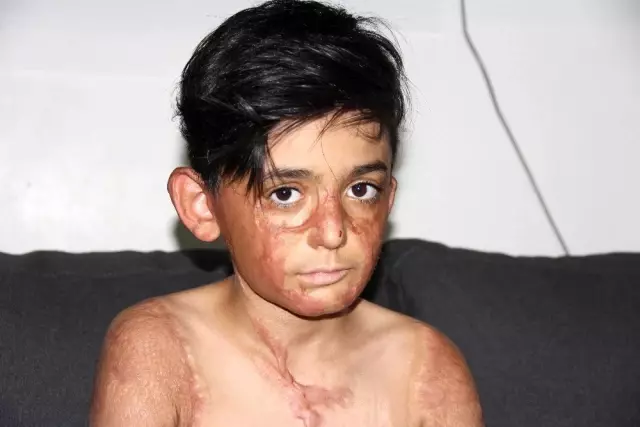(Özel) Vücudu yanan Umut'un acı çığlığı: