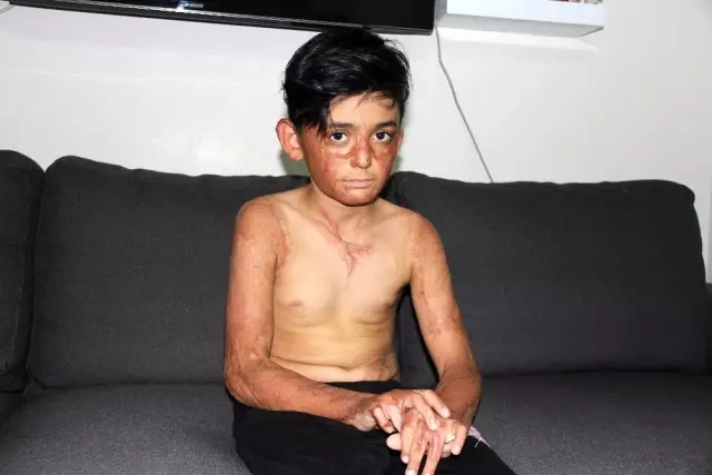 (Özel) Vücudu yanan Umut'un acı çığlığı: 'Eski derimi istiyorum' (Özel) Vücudu yanan Umut'un acı çığlığı: 'Eski derimi istiyorum'