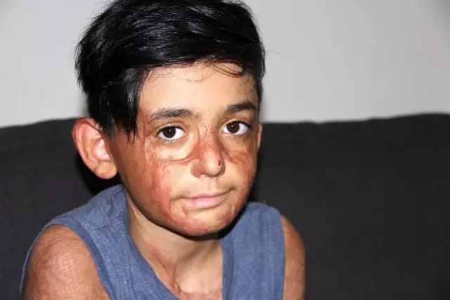 (Özel) Vücudu yanan Umut'un acı çığlığı: 'Eski derimi istiyorum' (Özel) Vücudu yanan Umut'un acı çığlığı: 'Eski derimi istiyorum'