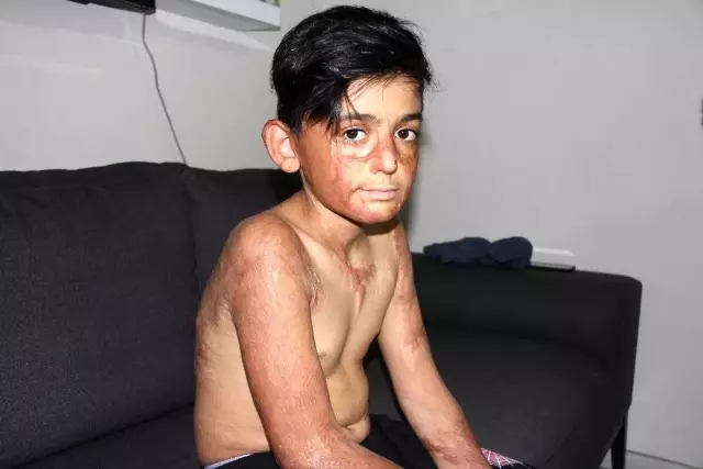 (Özel) Vücudu yanan Umut'un acı çığlığı: 'Eski derimi istiyorum' (Özel) Vücudu yanan Umut'un acı çığlığı: 'Eski derimi istiyorum'