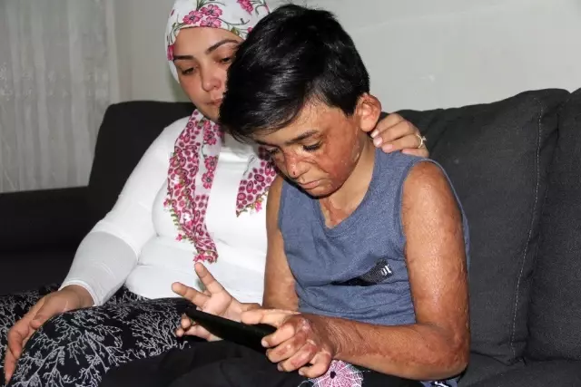 (Özel) Vücudu yanan Umut'un acı çığlığı: 'Eski derimi istiyorum' (Özel) Vücudu yanan Umut'un acı çığlığı: 'Eski derimi istiyorum'
