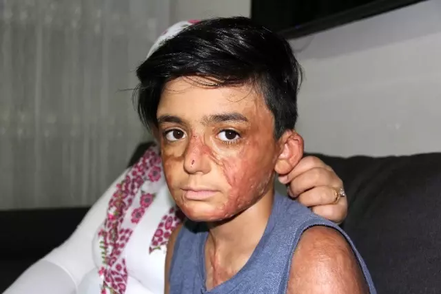 (Özel) Vücudu yanan Umut'un acı çığlığı: 'Eski derimi istiyorum' (Özel) Vücudu yanan Umut'un acı çığlığı: 'Eski derimi istiyorum'