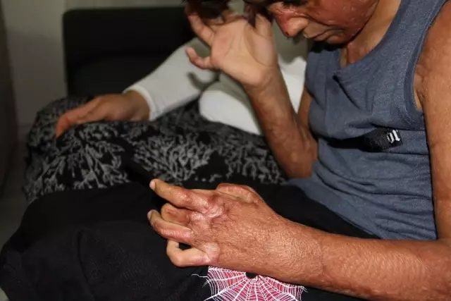 (Özel) Vücudu yanan Umut'un acı çığlığı: 'Eski derimi istiyorum' (Özel) Vücudu yanan Umut'un acı çığlığı: 'Eski derimi istiyorum'