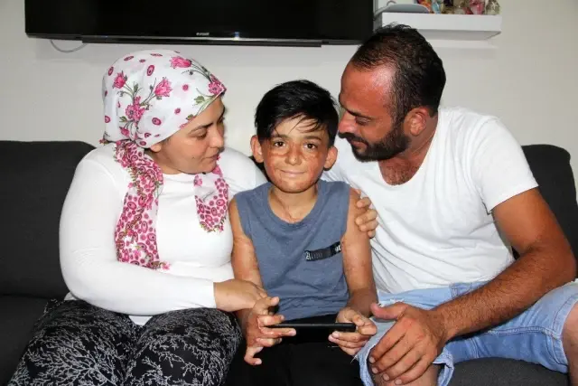 (Özel) Vücudu yanan Umut'un acı çığlığı: 'Eski derimi istiyorum' (Özel) Vücudu yanan Umut'un acı çığlığı: 'Eski derimi istiyorum'