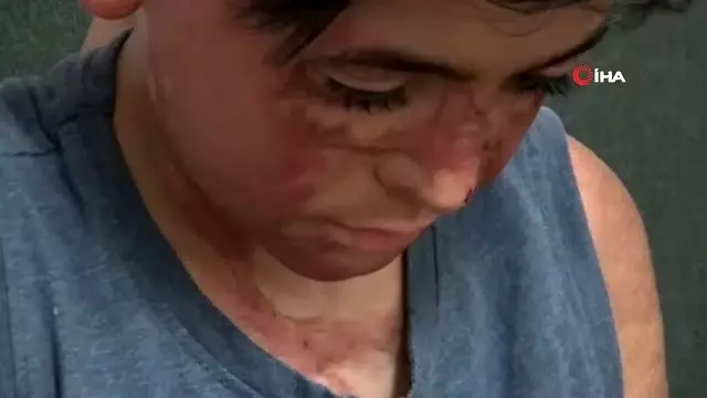 Vücudunun yüzde 50'si yanan Umut'un acı çığlığı: 'Eski derimi istiyorum' Vücudunun yüzde 50'si yanan Umut'un acı çığlığı: 'Eski derimi istiyorum'