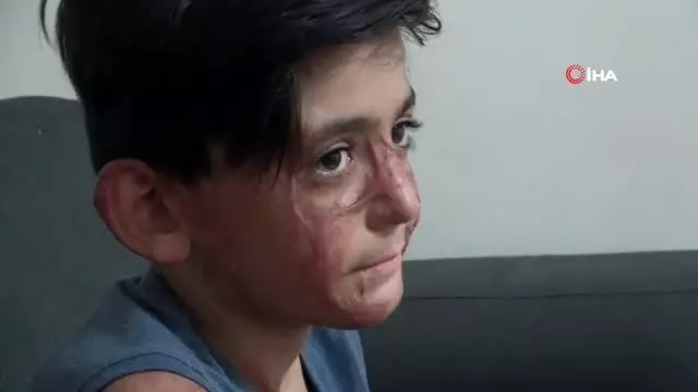 Vücudunun yüzde 50'si yanan Umut'un acı çığlığı: 'Eski derimi istiyorum' Vücudunun yüzde 50'si yanan Umut'un acı çığlığı: 'Eski derimi istiyorum'