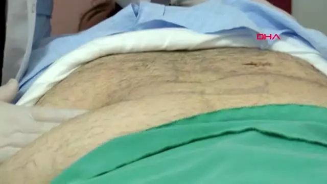 Almanya'dan zonguldak'a gelip tüp mide ameliyatı oldu Almanya'dan zonguldak'a gelip tüp mide ameliyatı oldu