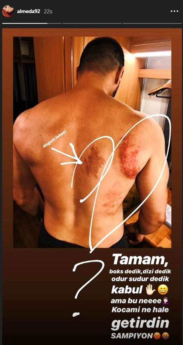 Almeda Abazi dizi için boks eğitimi alan Tolgahan Sayışman'ın vücudunun morarmasına sitem etti