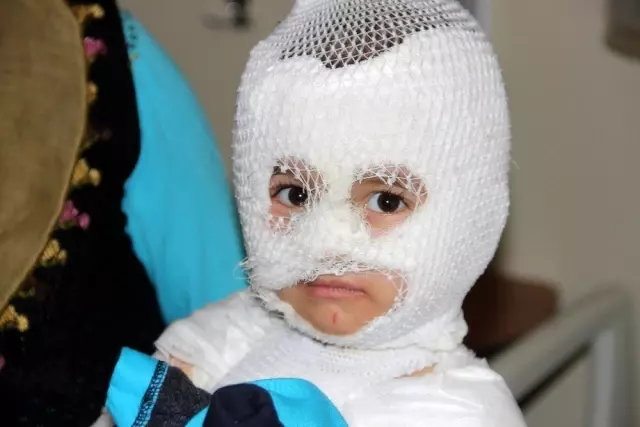 Isıtıcıdaki kaynar su üzerine dökülen çocuk ölümden döndü Isıtıcıdaki kaynar su üzerine dökülen çocuk ölümden döndü