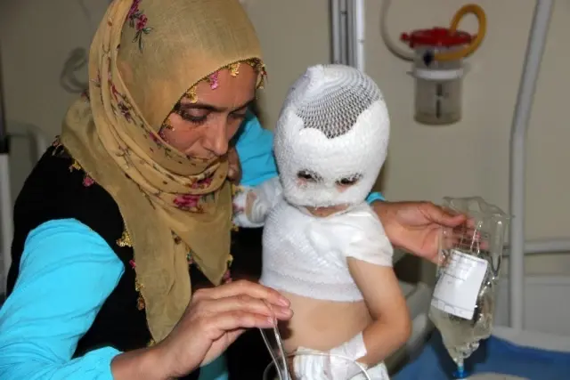 Isıtıcıdaki kaynar su üzerine dökülen çocuk ölümden döndü Isıtıcıdaki kaynar su üzerine dökülen çocuk ölümden döndü