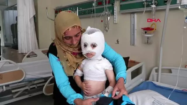 Üzerine ısıtıcıdaki kaynar suyun döküldüğü yunus emre, yaralandı Üzerine ısıtıcıdaki kaynar suyun döküldüğü yunus emre, yaralandı