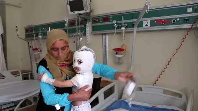 Üzerine ısıtıcıdaki kaynar suyun döküldüğü yunus emre, yaralandı Üzerine ısıtıcıdaki kaynar suyun döküldüğü yunus emre, yaralandı