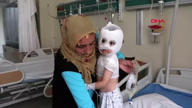 Üzerine ısıtıcıdaki kaynar suyun döküldüğü yunus emre, yaralandı Üzerine ısıtıcıdaki kaynar suyun döküldüğü yunus emre, yaralandı