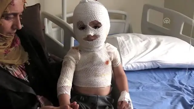Üzerine kaynar su dökülen minik Yunus Emre iyileşeceği günü bekliyor Üzerine kaynar su dökülen minik Yunus Emre iyileşeceği günü bekliyor