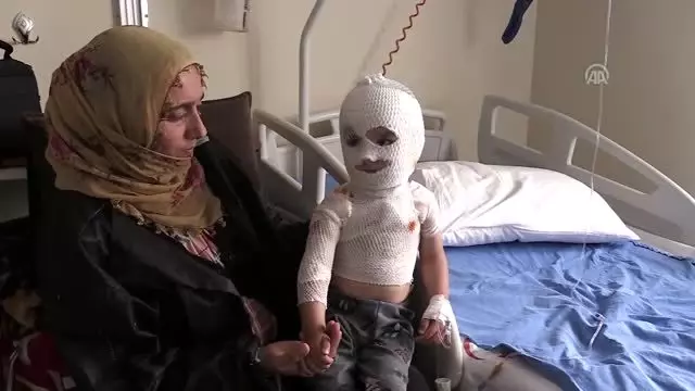 Üzerine kaynar su dökülen minik Yunus Emre iyileşeceği günü bekliyor Üzerine kaynar su dökülen minik Yunus Emre iyileşeceği günü bekliyor