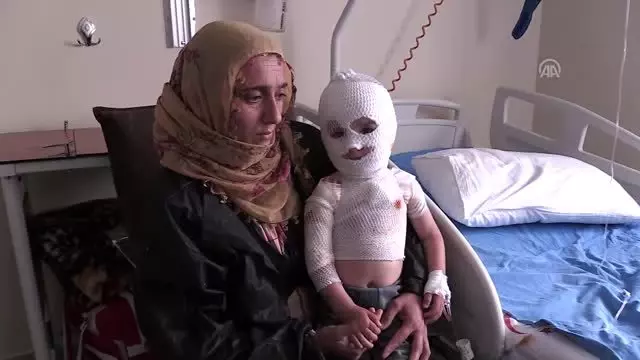 Üzerine kaynar su dökülen minik Yunus Emre iyileşeceği günü bekliyor Üzerine kaynar su dökülen minik Yunus Emre iyileşeceği günü bekliyor