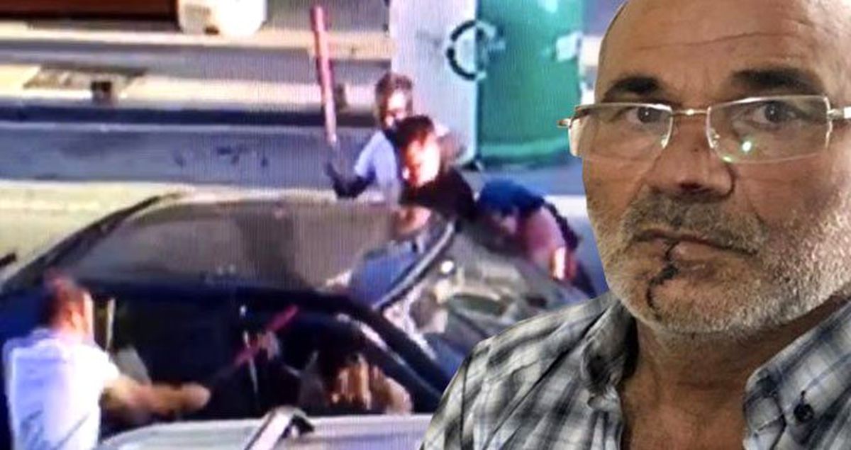 Öfkeli damat, kayınpederinin dudağını ısırarak parçaladı
