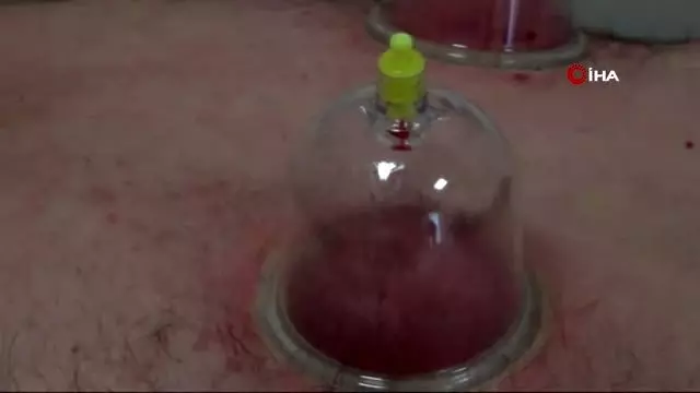 Dr. Ender Saraç: Sonbahar'da hacamat yaptırmayı ihmal etmeyin Dr. Ender Saraç: Sonbahar'da hacamat yaptırmayı ihmal etmeyin