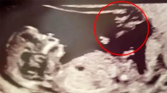 Ultrasondaki esrarengiz görüntü tartışma yarattı