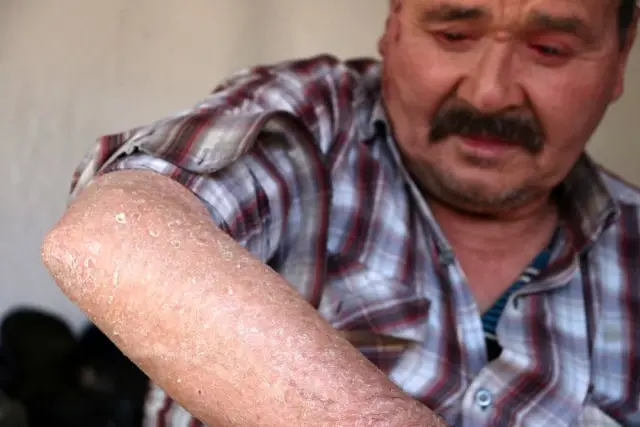 'Balık pulu' hastalığı vatandaşların kabusu oldu 'Balık pulu' hastalığı vatandaşların kabusu oldu