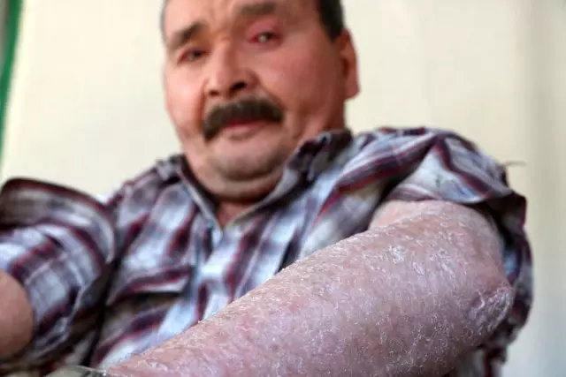 'Balık pulu' hastalığı vatandaşların kabusu oldu 'Balık pulu' hastalığı vatandaşların kabusu oldu