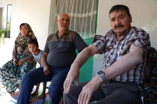 'Balık pulu' hastalığı vatandaşların kabusu oldu 'Balık pulu' hastalığı vatandaşların kabusu oldu
