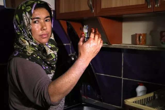 'Balık pulu' hastalığı vatandaşların kabusu oldu 'Balık pulu' hastalığı vatandaşların kabusu oldu
