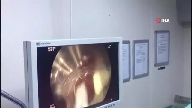 Karın ağrısı şikayetiyle hastaneye giden kadının midesinden çıkan şok etti Karın ağrısı şikayetiyle hastaneye giden kadının midesinden çıkan şok etti