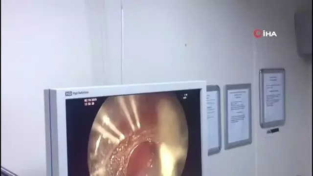 Karın ağrısı şikayetiyle hastaneye giden kadının midesinden çıkan şok etti Karın ağrısı şikayetiyle hastaneye giden kadının midesinden çıkan şok etti