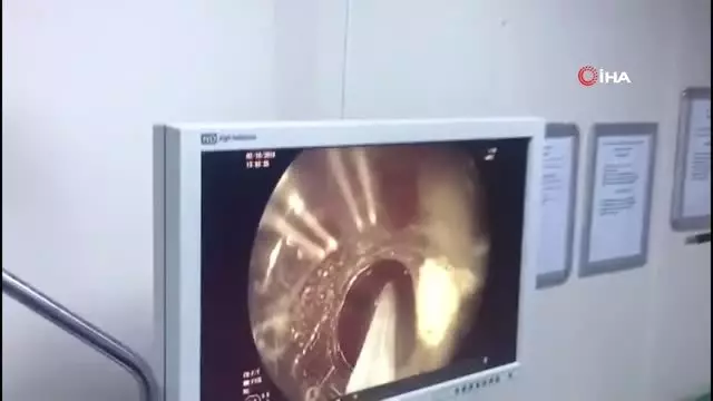 Karın ağrısı şikayetiyle hastaneye giden kadının midesinden çıkan şok etti Karın ağrısı şikayetiyle hastaneye giden kadının midesinden çıkan şok etti