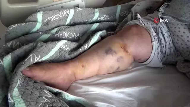 Koroner bypass cerrahisinde endoskopik yöntem kısa sürede iyileştiriyor