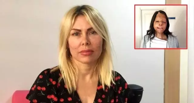 Yangında yanan yüzüne doku nakli yapılan Firdevs, 2 ameliyat daha olacak