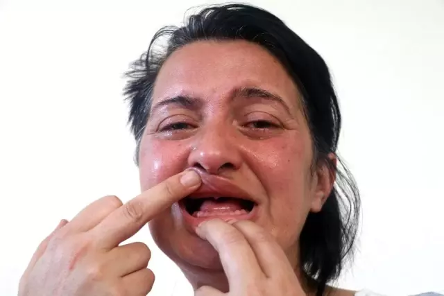 Beyaz diş hayaliyle 32 dişinden olmuştu! Bu kez de unutkanlıktan şikâyetçi Beyaz diş hayaliyle 32 dişinden olmuştu! Bu kez de unutkanlıktan şikâyetçi