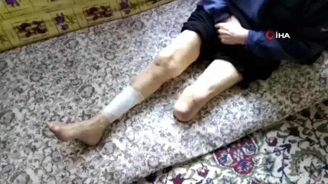Bir bacağı kesilen ve vücudunda yaralar çıkan şeker hastası adam yardım bekliyor Bir bacağı kesilen ve vücudunda yaralar çıkan şeker hastası adam yardım bekliyor
