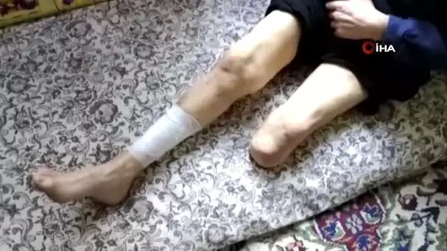 Bir bacağı kesilen ve vücudunda yaralar çıkan şeker hastası adam yardım bekliyor Bir bacağı kesilen ve vücudunda yaralar çıkan şeker hastası adam yardım bekliyor