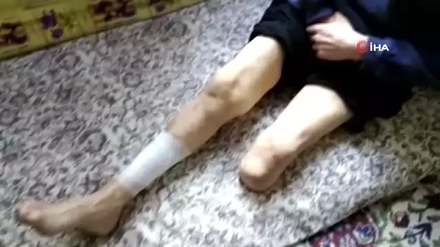 Bir bacağı kesilen ve vücudunda yaralar çıkan şeker hastası adam yardım bekliyor Bir bacağı kesilen ve vücudunda yaralar çıkan şeker hastası adam yardım bekliyor